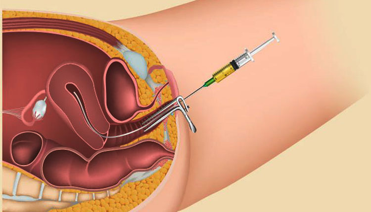 iui treatment in bargarh